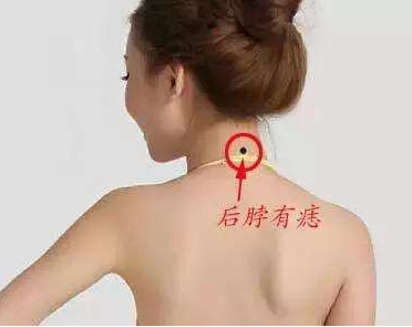 脖子后面有痣代表什么，男女脖子后面有痣圖解