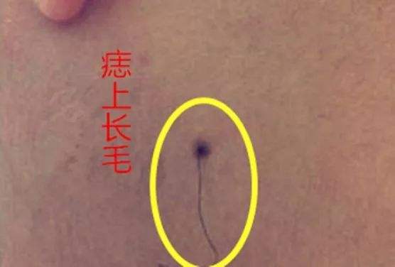 痣毛剪掉會影響運(yùn)氣嗎，破壞運(yùn)氣的痣長在哪里